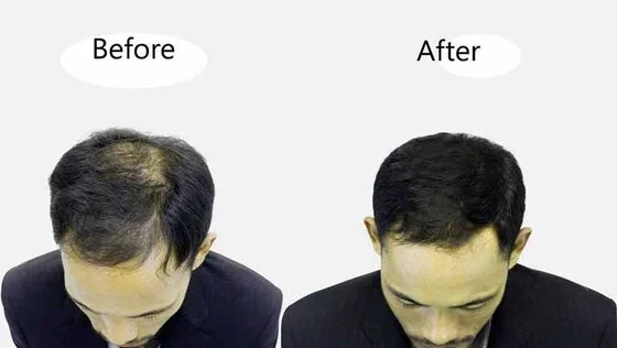 Hair Transplant Post Care Image