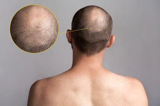 A Guide To Taking Finasteride For Male Pattern Baldness And Hair Loss Image