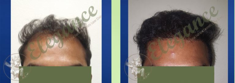 Dr Ashutosh Shah Hair Result