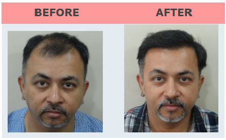 Dr Manoj Hhanna Hair Result
