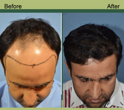 Dr Tejinder Bhati Hair Result