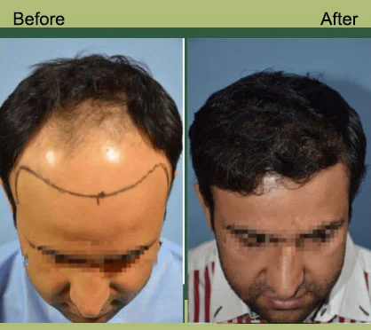 Dr Tejinder Bhati Hair Result