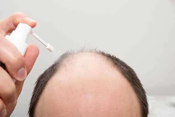 Androgenetic Alopecia