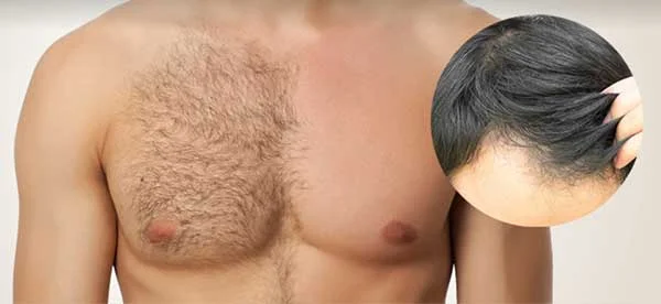 Body Hair Transplant