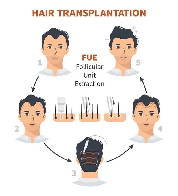 Fue Hairtransplant.webp