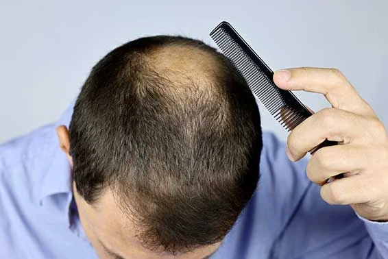 Hair Loss Symptoms