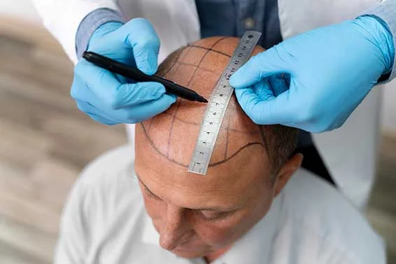 Hair Transplant Surgery