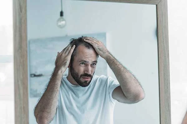 Male Pattern Baldness