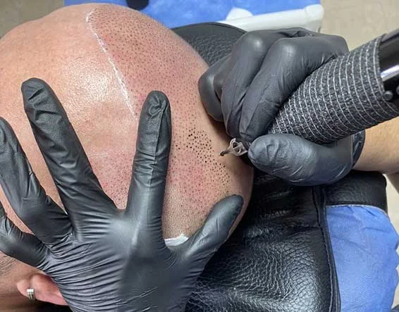 Scalp Micropigmentation